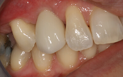 Results of low cost dental implants near me in Edinburgh Scotland