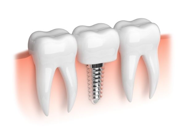 dental implants near me Edinburgh