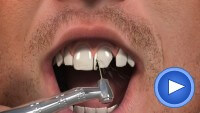 Dental Crown Medivision Video