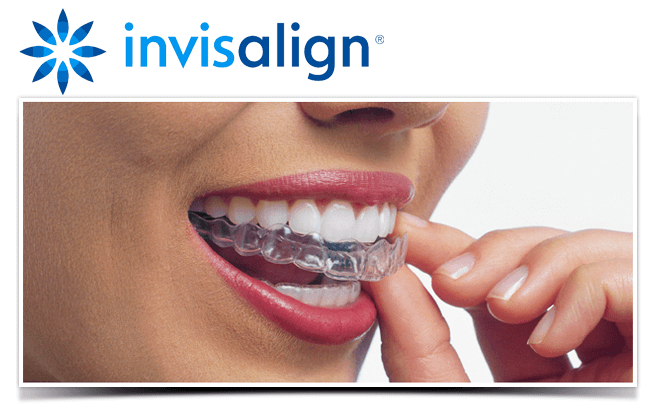 Cost of Invisalign, Invisible Braces